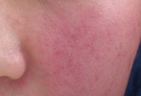 如何拯救你的敏感??？廣西南寧美容培訓(xùn)叫你正確方法