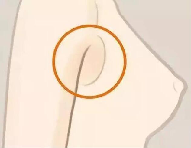 減副乳，瘦手臂一招就解決！