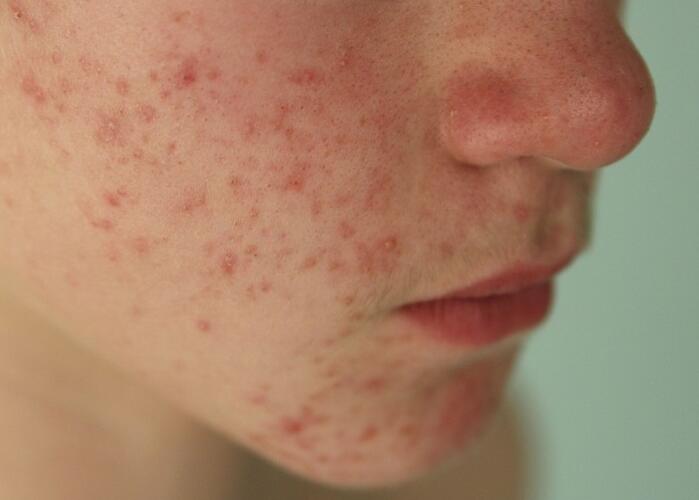 粉刺閉口應該如何處理？