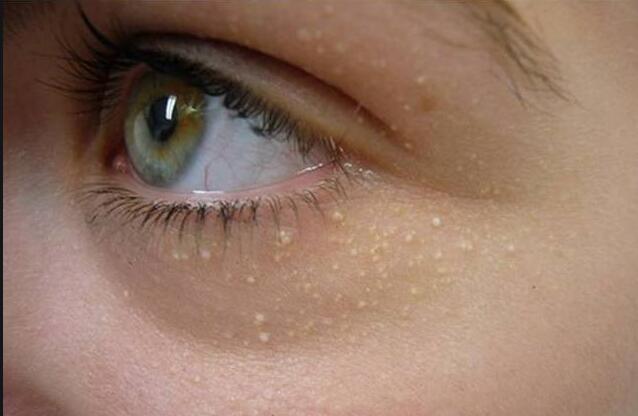 5個去除眼部脂肪粒的美容技巧