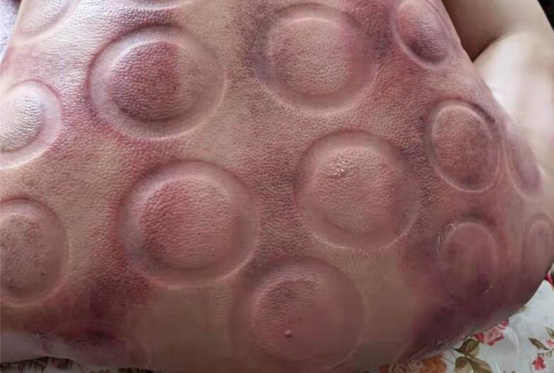 怎樣拔火罐？南寧美容學(xué)校手把手教你