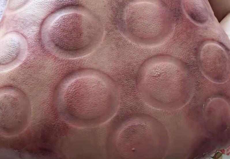 拔火罐有什么用？廣西美容職業(yè)培訓(xùn)學(xué)校演示給你看