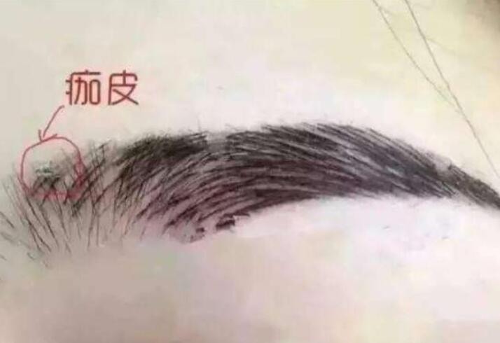 紋眉結痂時要注意什么？麗紋竹繡學校教你