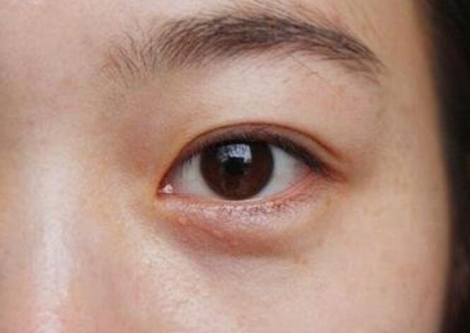 黑眼圈的種類有哪些？廣西美容培訓(xùn)教你保養(yǎng)