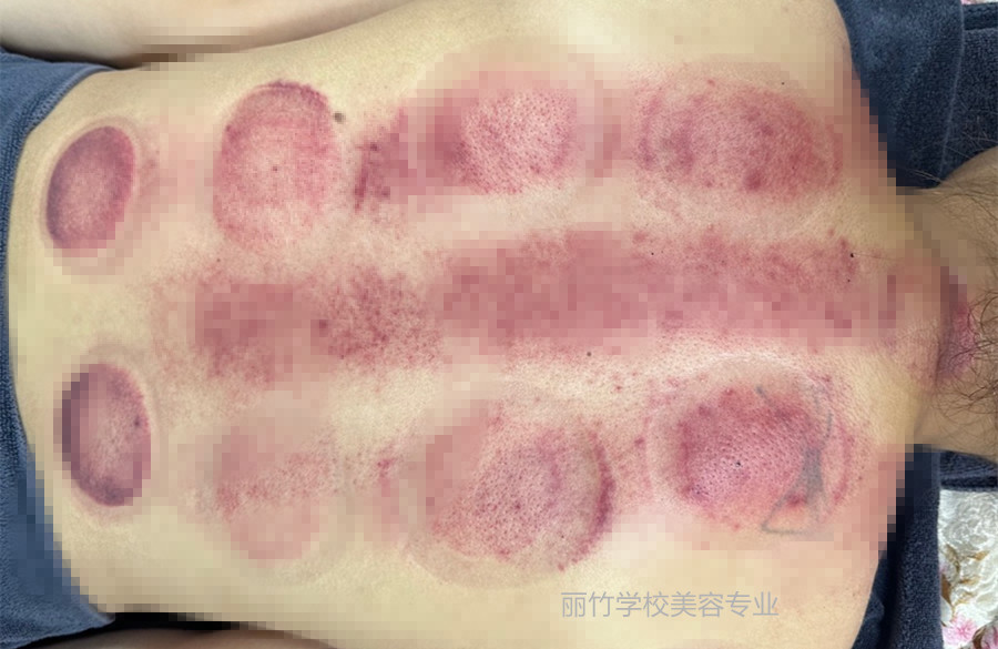 拔火罐的顏色代表什么？南寧美容美體專業(yè)實訓