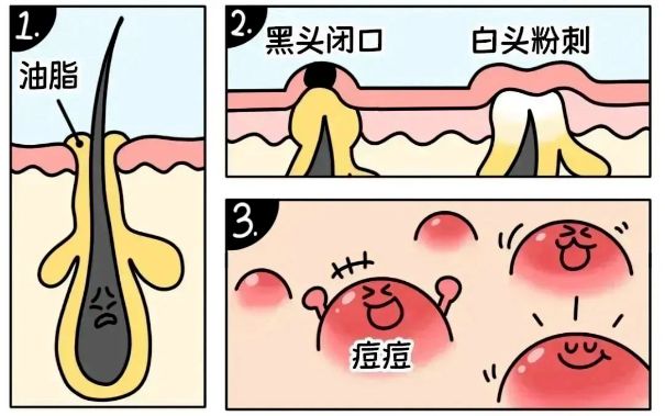 不同部位閉口形成的原因，南寧美容護膚學(xué)校解答