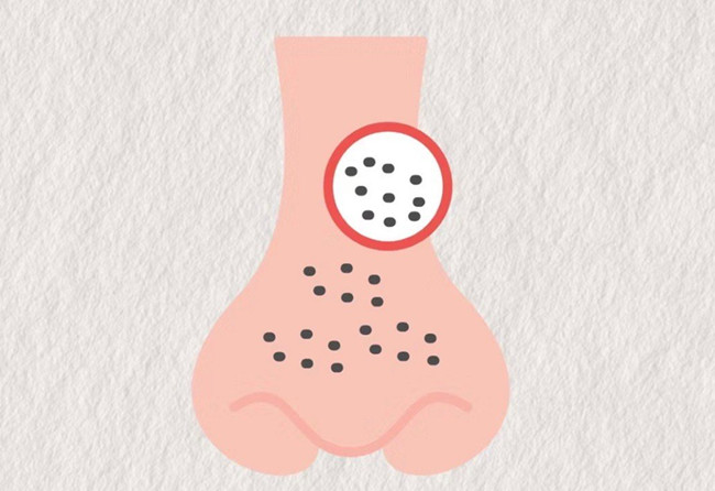 廣西皮膚管理師：面對嚴重的黑頭應該怎么辦？